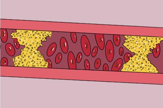 血管硬化、狭窄和血栓形成